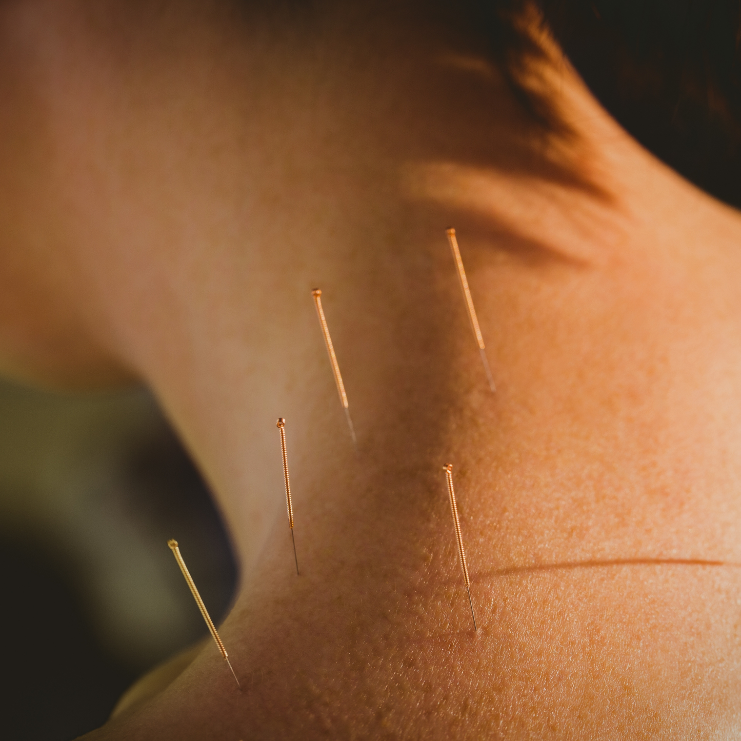 Acupuncture Therapy on Womans Neck
